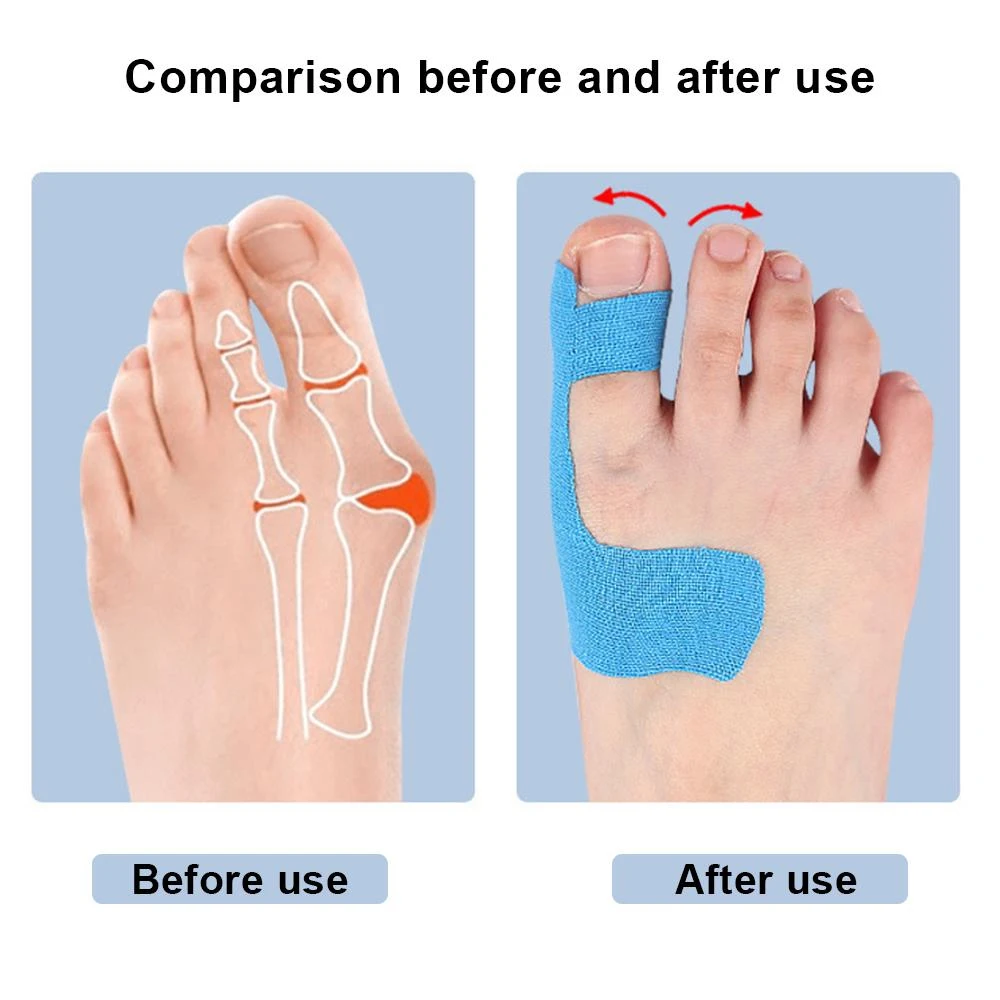 Hallux-Valgus-Korrekturband für Ballenzehen 2
