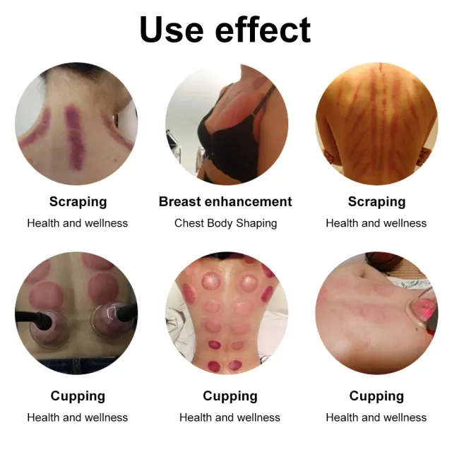 Lymphdrainage-Schröpfset 4